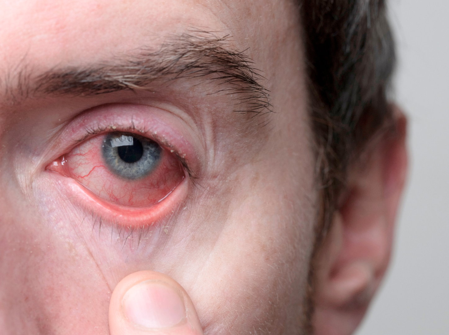 Combate la alergia en los ojos